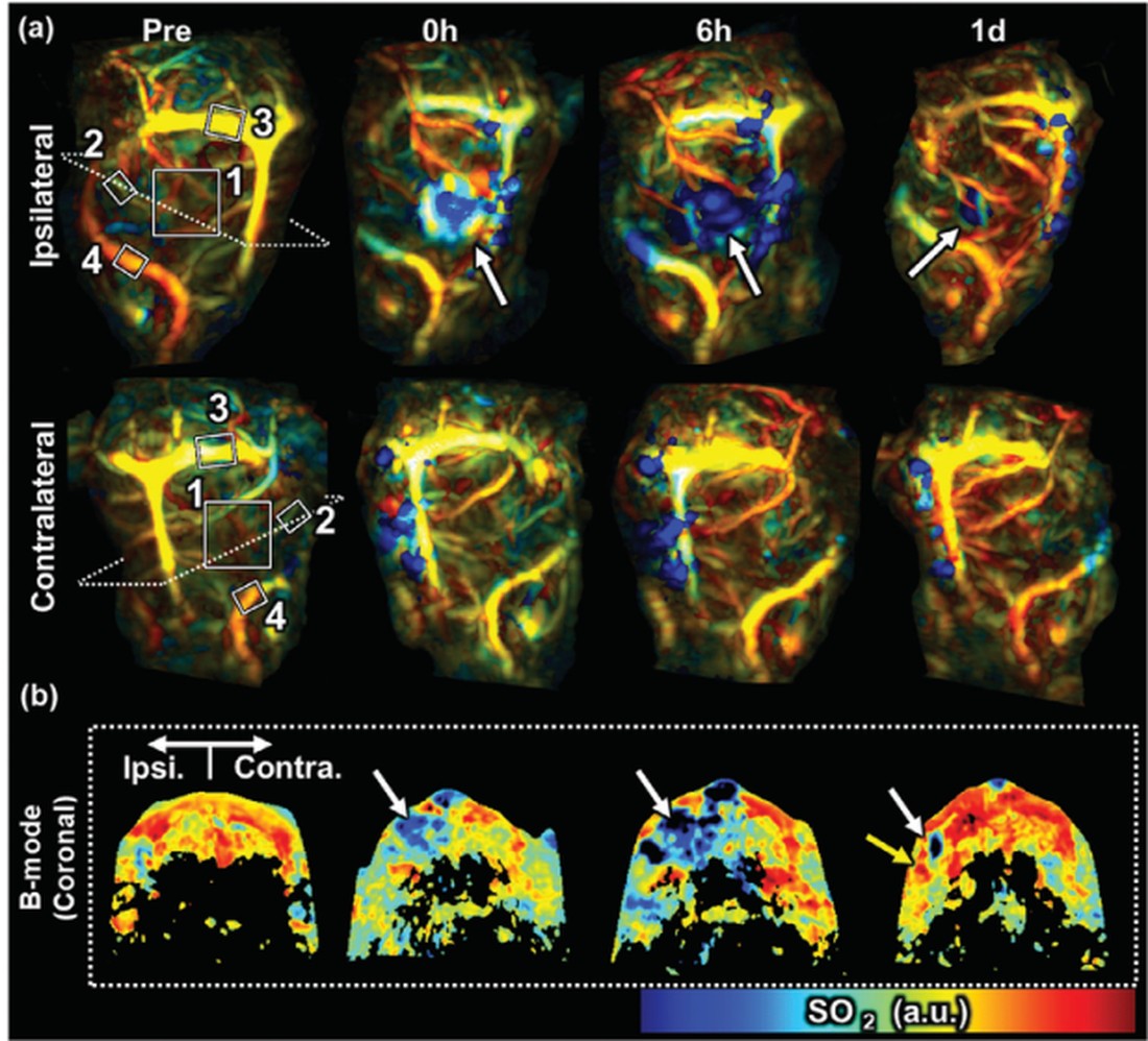 Photoacoustic oxygen saturation monitoring after ischemic stroke